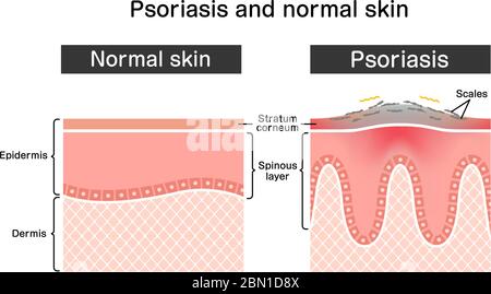 Querschnitt von Psoriasis und normaler Haut / flache Vektorgrafik Stock Vektor