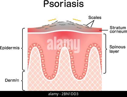 Querschnitt der Psoriasis Haut / flache Vektor-Illustration Stock Vektor