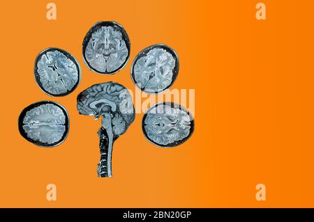 MRT des Kopfes auf einem orangefarbenen Hintergrund. Das Konzept der rechtzeitigen Erkennung von Erkrankungen des Kopfes. Psychische Gesundheit. Stockfoto