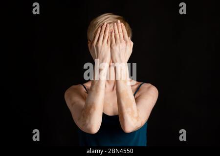 Problem bei der Kommunikation. Frauen mit Vitiligo, Freiraum Stockfoto