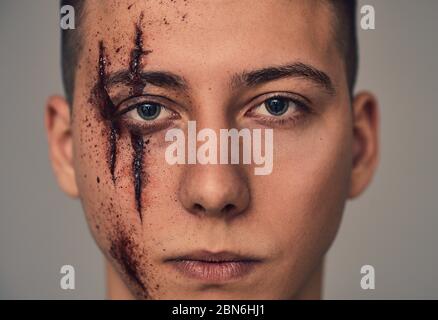 Teenager mit Wunden im Gesicht. Mobbing und Belästigung. Stockfoto