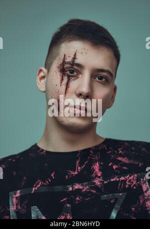 Teenager mit Wunden im Gesicht. Mobbing und Belästigung. Stockfoto