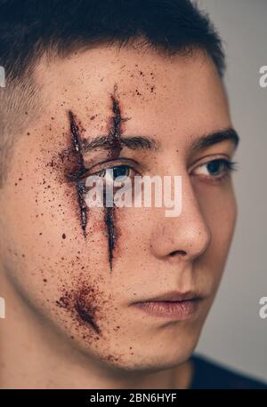 Teenager mit Wunden im Gesicht. Mobbing und Belästigung. Stockfoto