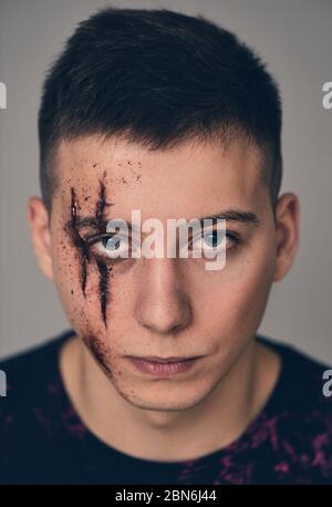 Teenager mit Wunden im Gesicht. Mobbing und Belästigung. Stockfoto