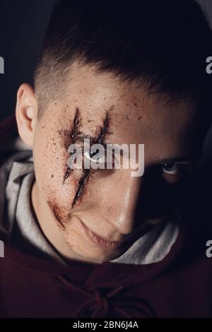 Teenager mit Wunden im Gesicht. Mobbing und Belästigung. Stockfoto