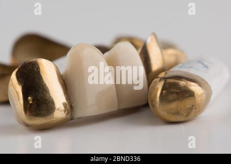 Gestanzte gelötete Zahnbrücken mit Gold auf weißem Hintergrund beschichtet Stockfoto