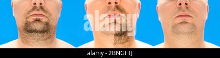 Vor und nach der Rasur. Collage des jungen Mannes mit unformierten, ungetrimmten, überwucherten Stoppeln, Haaren auf Gesicht und Hals, halb und mit vollständig rasiert Stockfoto