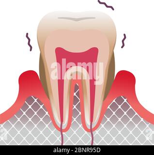Parodontalkrankheit Zahn und Zahnfleisch flach Vektor Illustration Stock Vektor
