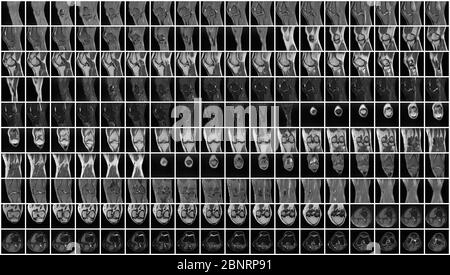 Vollständige Magnetresonanztomographie (MRT) des linken Knies Stockfoto
