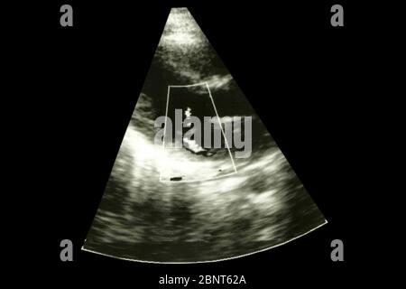 Verschwommenes Ultraschallbild des Herzens. Screening mit fetaler Echokardiographie. Symbol Diagnostik im Gesundheitswesen Stockfoto