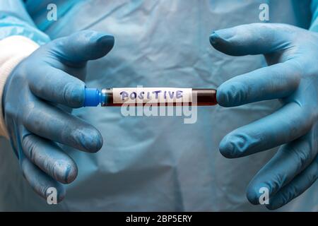 Ein Arzt zeigt ein Reagenzglas mit positiven Ergebnissen. Hand mit Handschuhen, die ein Reagenzglas mit Blut hält. Ein Labor Forschung des Blutes. Stockfoto