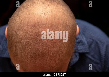 Draufsicht auf den Glatzkopf eines Mannes, zurückgeriedenen Haaransatz. Isoliert auf schwarzem Hintergrund Stockfoto