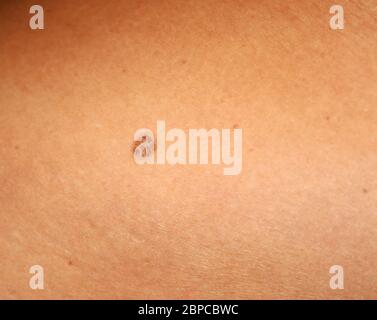 Braune Flecken auf der Haut. Spot dunkel. Stockfoto