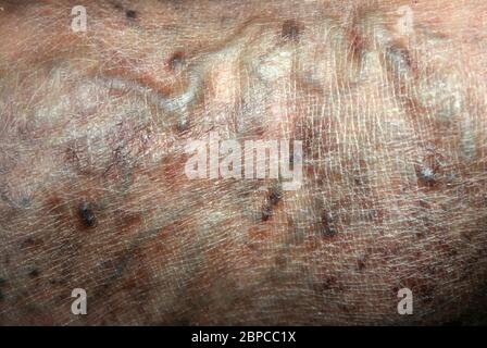 Krampfadern. Phlebeurysm. Thrombophlebitis. Bein in den Venen Stockfoto