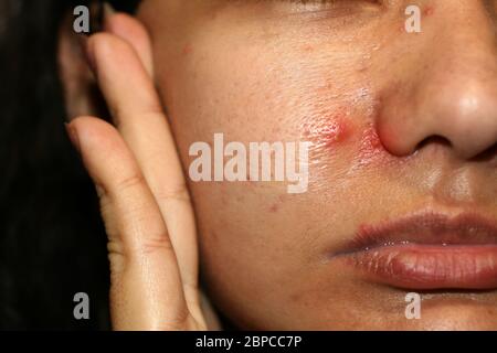 Entzündung auf der Haut des Gesichts. Rote Noppen eitrig. Akne. Keloidnarben. Erweiterte Poren Stockfoto