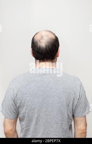 Rückansicht des Haarverlustes im mittleren Alter Mann Stockfoto