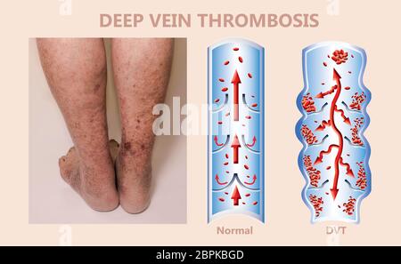 Economy class Syndrom Mechanismus, tiefe Beinvenenthrombose, Lungenembolie oder PE, koronare Thrombose, Illustration Grafik männliche Beine Stockfoto