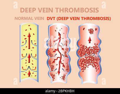 Thrombose. Von den normalen Blutfluss zu Blutgerinnsel und Blutgerinnsel, die durch den Blutstrom reist. embolie. Illustration für Biologische, med Stockfoto