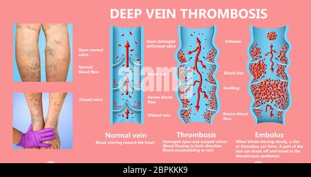 Tiefe Venenthrombose oder Blutgerinnsel. Embolus. Struktur der normalen weiblichen Venen und Krampfadern Stockfoto