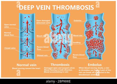 Thrombose. Von den normalen Blutfluss zu Blutgerinnsel und Blutgerinnsel, die durch den Blutstrom reist. Embolie. Abbildung für Biologische, medi Stockfoto