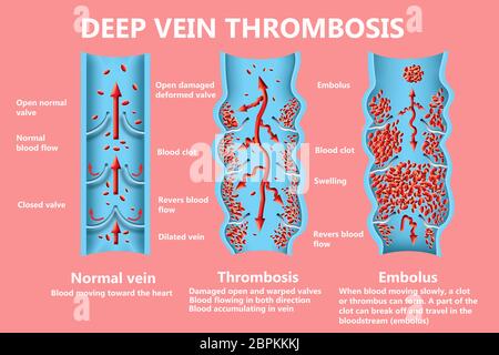 Thrombose. Von den normalen Blutfluss zu Blutgerinnsel und Blutgerinnsel, die durch den Blutstrom reist. Embolie. Abbildung für Biologische, medi Stockfoto