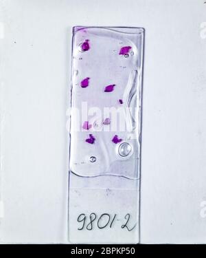 Schichten des Tumors unter Glas. Die histologische Untersuchung der tumorzellen Für die Anwesenheit von Krebs. Proben von Tumorzellen unter dem eleganten gegen Th Stockfoto