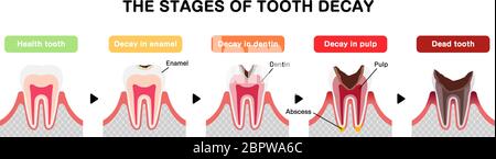 Die Stadien der Karies / flache Vektor-Illustration Stock Vektor