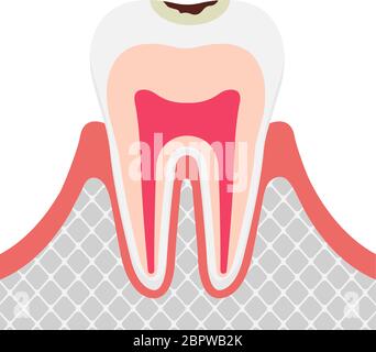 Das Stadium der Karies / Karies im Zahnschmelz Stock Vektor