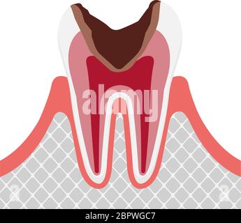 Das Stadium der Karies / Karies in der Zellstoff Stock Vektor