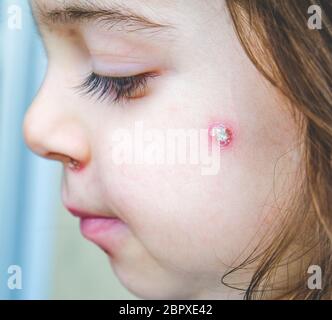 Windpocken spot details Gesicht Nahaufnahme spots Baby Gesicht seitliche Wange. Stockfoto