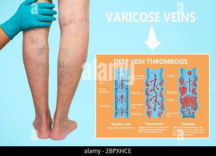 Thrombose. Von den normalen Blutfluss zu Blutgerinnsel und Blutgerinnsel, die durch den Blutstrom reist. Embolie. biologischen, medizinischen und Wissenschaft Stockfoto