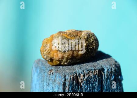 Gallenblase Stein. Das Ergebnis von Gallensteinen. Kalkül der heterogenen Zusammensetzung Stockfoto