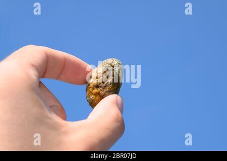 Stein der Gallenblase. Das Ergebnis von Gallensteinen. Ein Kalkül der heterogenen Zusammensetzung vor blauem Himmel. Stockfoto