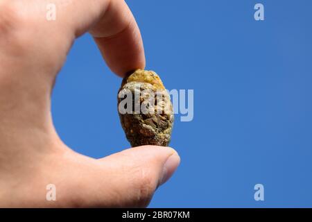 Stein der Gallenblase. Das Ergebnis von Gallensteinen. Ein Kalkül der heterogenen Zusammensetzung vor blauem Himmel. Stockfoto