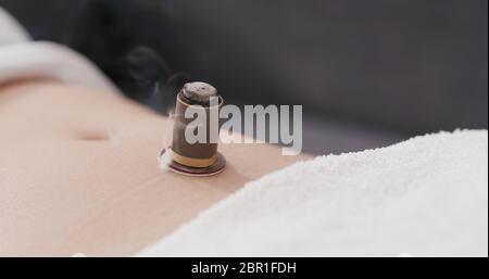 Chinesische traditionelle Medizin Moxibustion Therapie Stockfoto