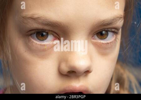 Gereizte Augen eines Mädchens, krank mit bindehautentzündung erhielt Stockfoto