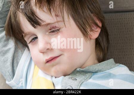 Kleiner Junge mit Stichen auf dem Auge. Stockfoto