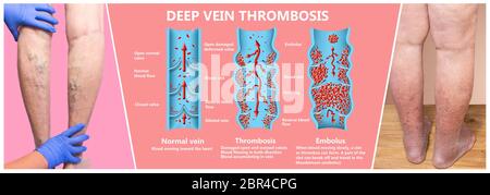 Tiefe Venenthrombose oder Blutgerinnsel. Embolus. Struktur der normalen weiblichen Venen und Krampfadern Stockfoto