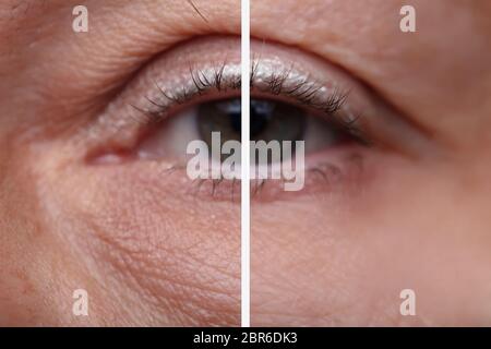Close-up Woman's Eye Beutel Vor und Nach der kosmetischen Behandlung Stockfoto