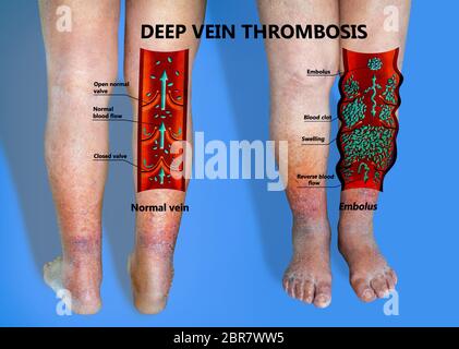 Nahaufnahme der Haut mit Krampfadern auf älteren männlichen Bein. Konzept der trockenen Haut, alte ältere Leute, Krampfadern Stockfoto