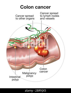 Abbildung zeigt große Verdauung mit Darmpolypen, Malignanzpolypen und Dickdarmkrebs und Ausbreitung in Lymphknoten und Gefäßen Stockfoto