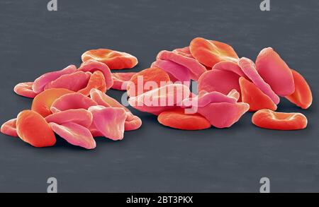 Rote Blutkörperchen. Farbige Rasterelektronenmikrograph (SEM) von roten Blutkörperchen (RBCs, Erythrozyten). Rote Blutkörperchen sind Biconhöhle, scheibenförmige Zellen, die Sauerstoff von der Lunge zu Körperzellen transportieren. Sie zirkulieren im Blut und entfernen auch Kohlendioxid in die Lunge für die Ausatmung. Ihre rote Farbe ist auf das sauerstoffführende Protein Hämoglobin zurückzuführen. Rote Blutkörperchen, die häufigste Zelle im Blut, haben keinen Kern und sind etwa 7 Mikrometer breit. Vergrößerung: 4000 bei Druck mit 10 Zentimetern Durchmesser. Stockfoto