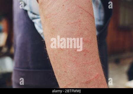 Hautallergie Krankheiten Problem, Giftbaum Kontakt Dermatitis Ausschlag durch Hose, Weibliche Dermatologie-Patient mit allergischem Ekzem am Arm Stockfoto