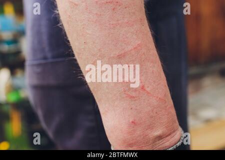 Hautallergie Krankheiten Problem, Giftbaum Kontakt Dermatitis Ausschlag durch Hose, Weibliche Dermatologie-Patient mit allergischem Ekzem am Arm Stockfoto