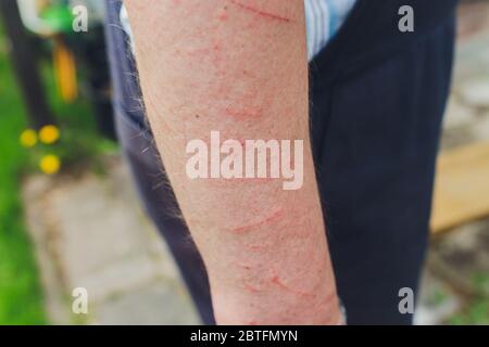 Hautallergie Krankheiten Problem, Giftbaum Kontakt Dermatitis Ausschlag durch Hose, Weibliche Dermatologie-Patient mit allergischem Ekzem am Arm Stockfoto