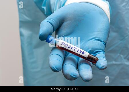 Ein Arzt zeigt ein Reagenzglas mit positiven Ergebnissen. Hand mit Handschuhen, die ein Reagenzglas mit Blut hält. Ein Labor Forschung des Blutes. Stockfoto