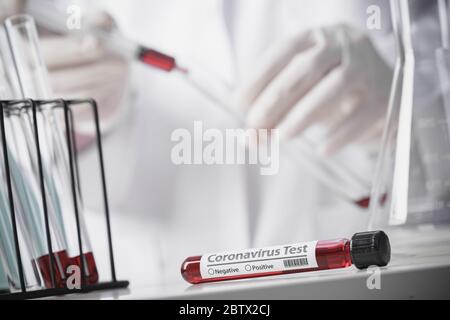 Tests von Patienten Blutproben auf Coronavirus Ausbruch (COVID-19) im Labor, New Coronavirus 2019-nCoV von Wuhan China Concept Stockfoto