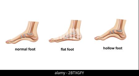 Medizinische Illustration des flachen Fußes Stockfoto