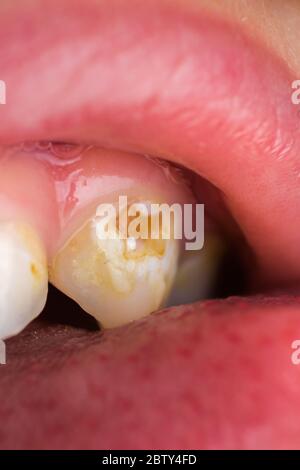Kind Patient offenen Mund zeigt Hohlräume Zähne Zerfall. Nahaufnahme von ungesunden Baby Zähne. Makro von Karies Zähne Zerfall Stockfoto