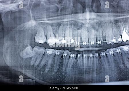 Röntgenaufnahme von menschlichen Zähnen mit einem Zahnspange-System. Verzögern Weisheitszahn Stockfoto